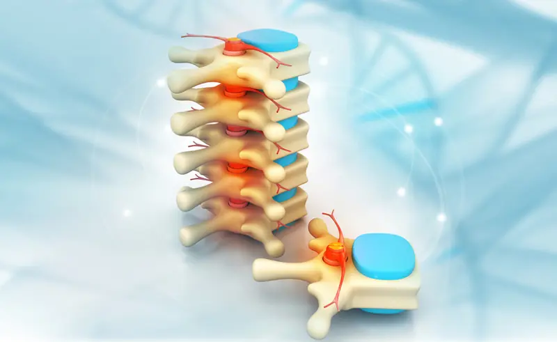 Open lumbar discectomy