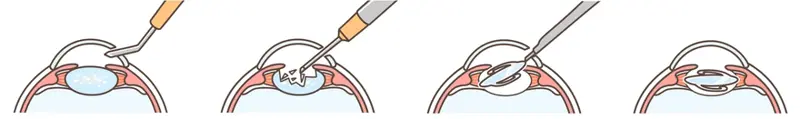 Toric Multifocal Lens Implantation Surgery