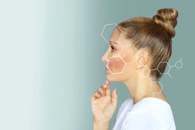 Melasma (Chloasma) Treatment