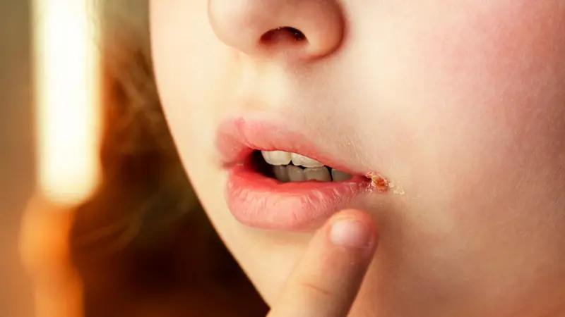 Angular Cheilitis Causes Symptoms Treatment