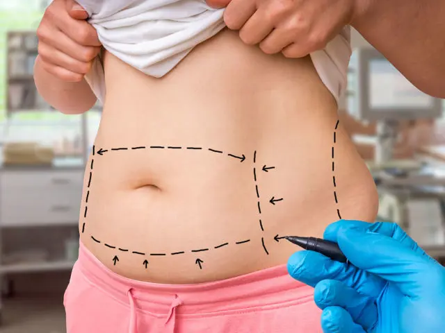 S-line Body Liposuction