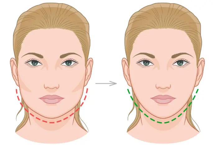 Jawline Contouring Surgery