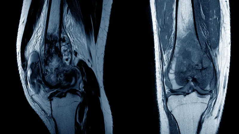 Musculoskeletal Tumor Treatment