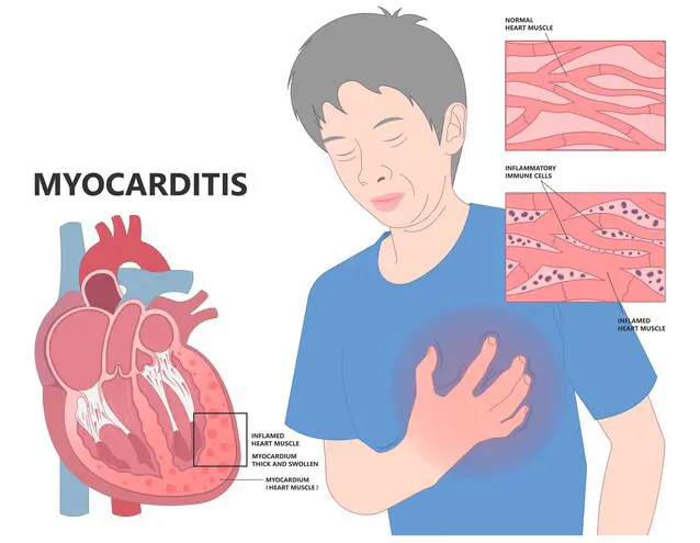 Treatment for Inflammatory Heart Disorders