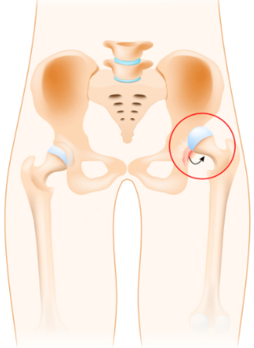 Congenital Hip Dislocation Surgery