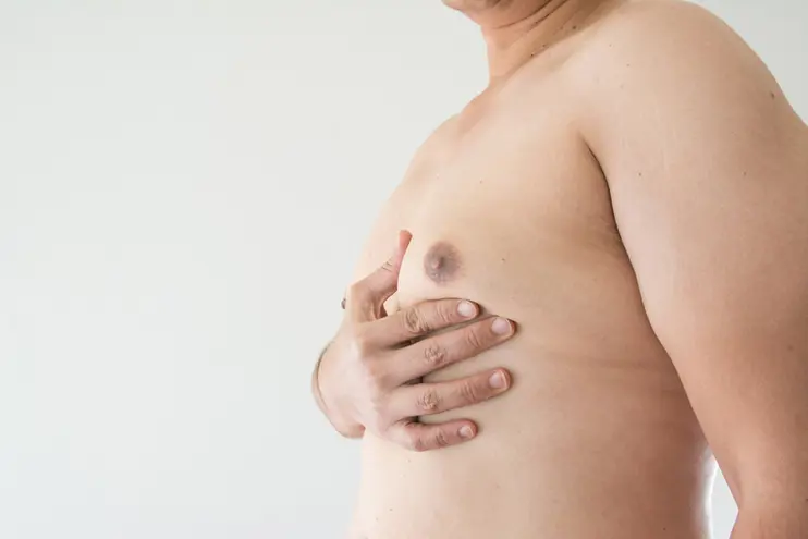 Enlargement of breasts in men Gynecomastia