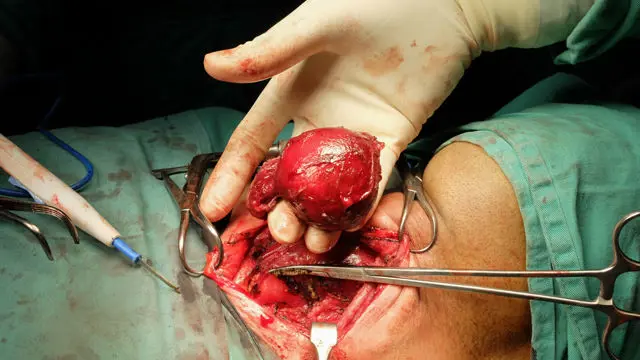 Cirugía de extirpación de adenoma paratiroideo