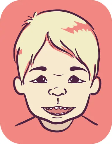 Angelman Syndrome: A Complete Guide to Causes, Symptoms, and Treatment ...