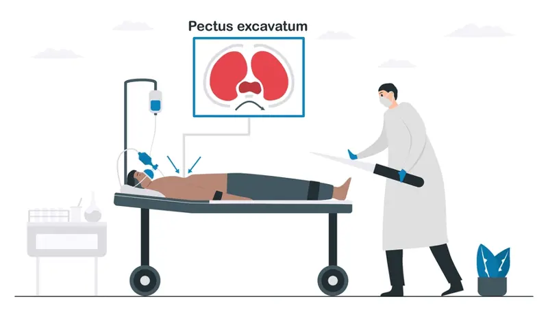 Pectus Excavatum Correction Surgery