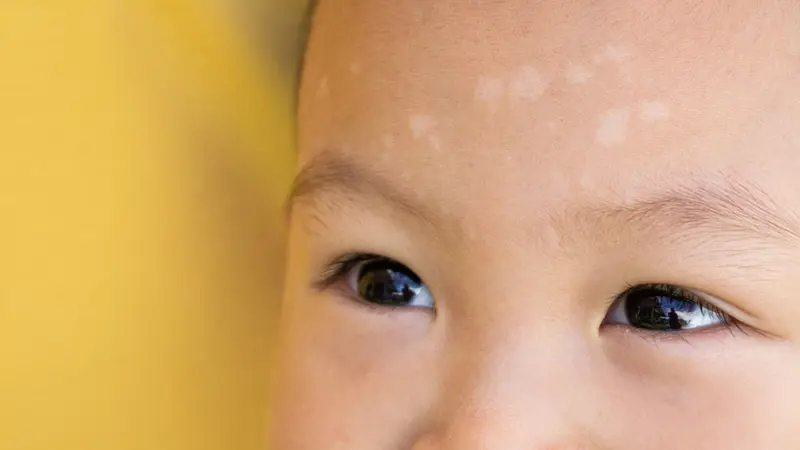 Fungal Skin Infection (Mycosis) Treatment