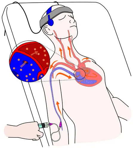 TCD Ultrasound for Brain Blood Flow Monitoring