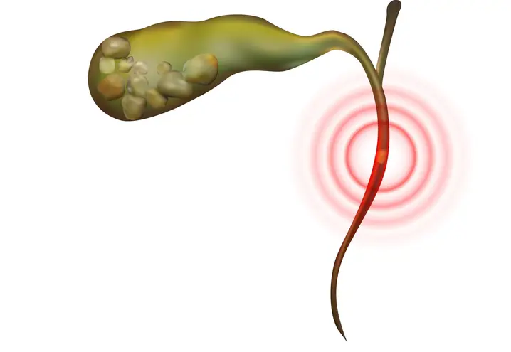 Endoscopic Bile Duct Surgery