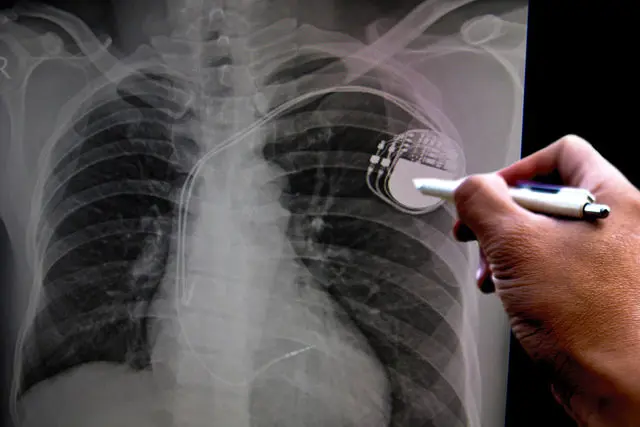 Pacemaker Implant Surgery