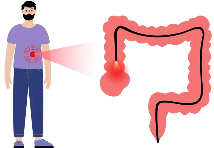 Endoscopic Polyp Removal