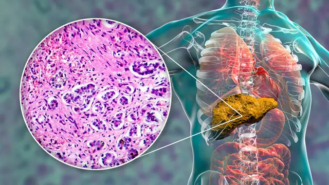 Liver Cancer Hepatocellular Carcinoma