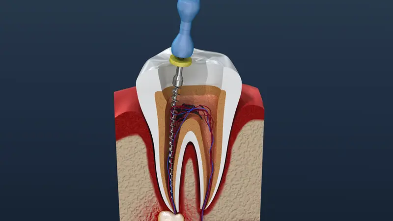 procedura canalare del dente anteriore