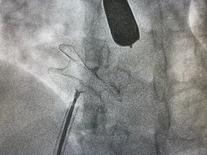ASD Closure with Device
