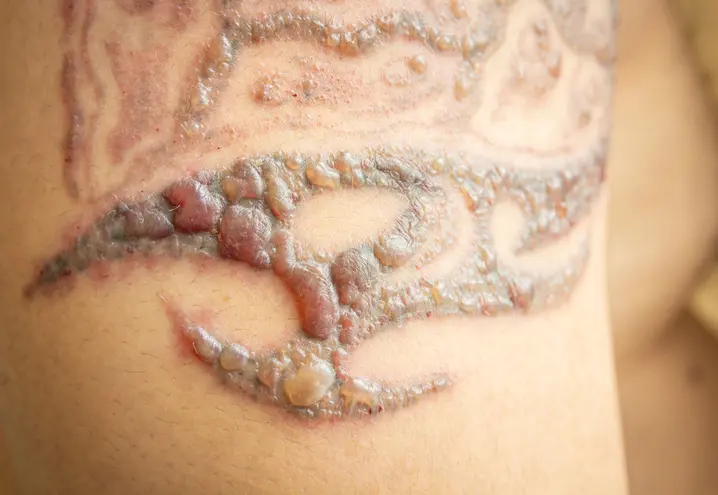 Химическое удаление татуировки - Удаление тату