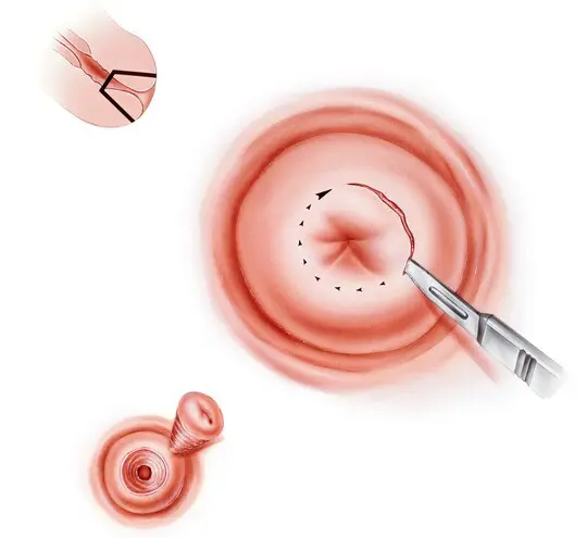 Laser Cervical Conization