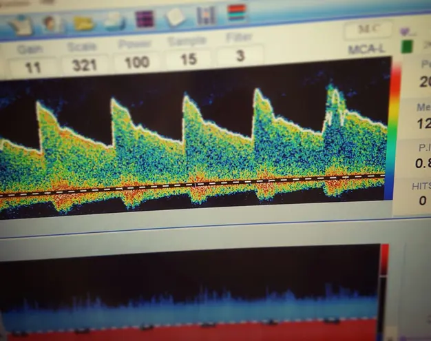 TCD Ultrasound for Brain Blood Flow Monitoring