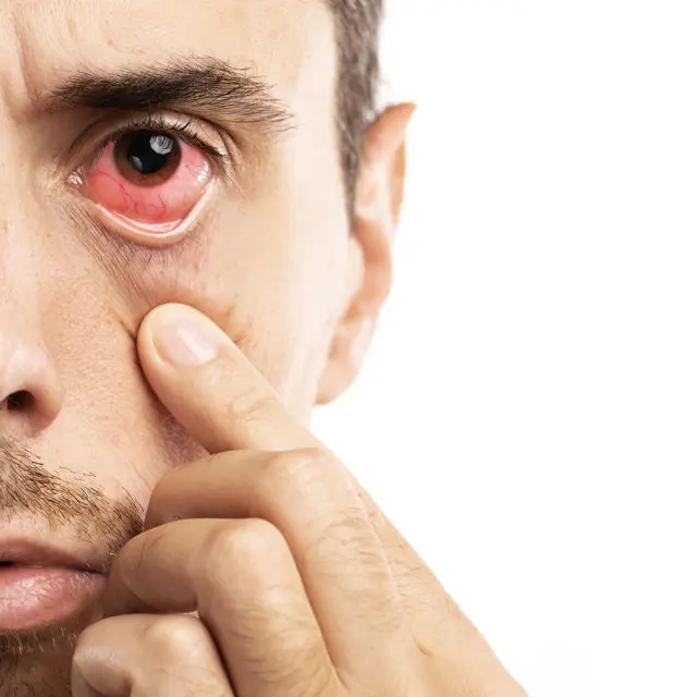 Dry eye syndrome