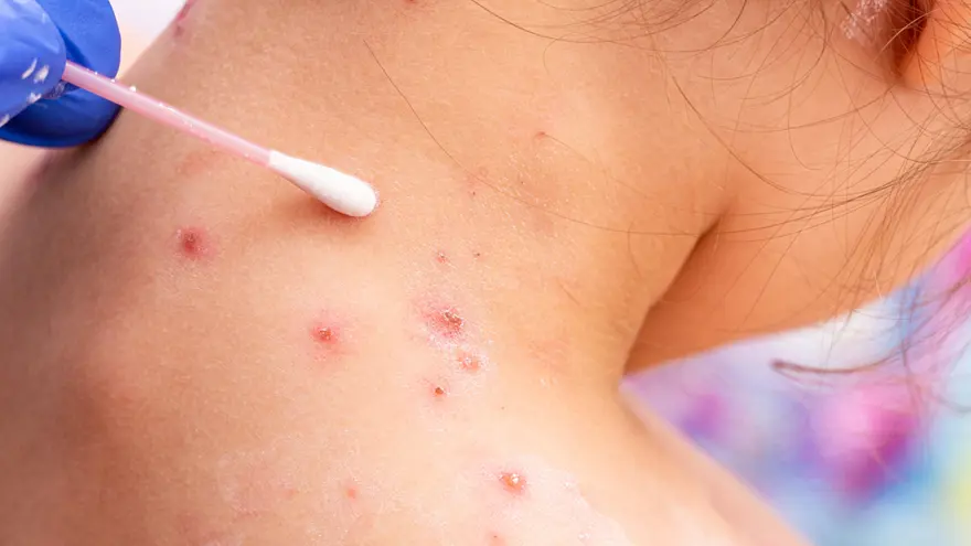 Skin Infections