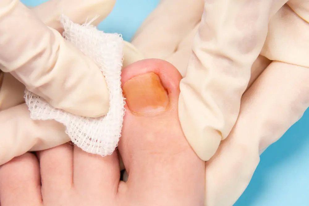 Nail Disorder
