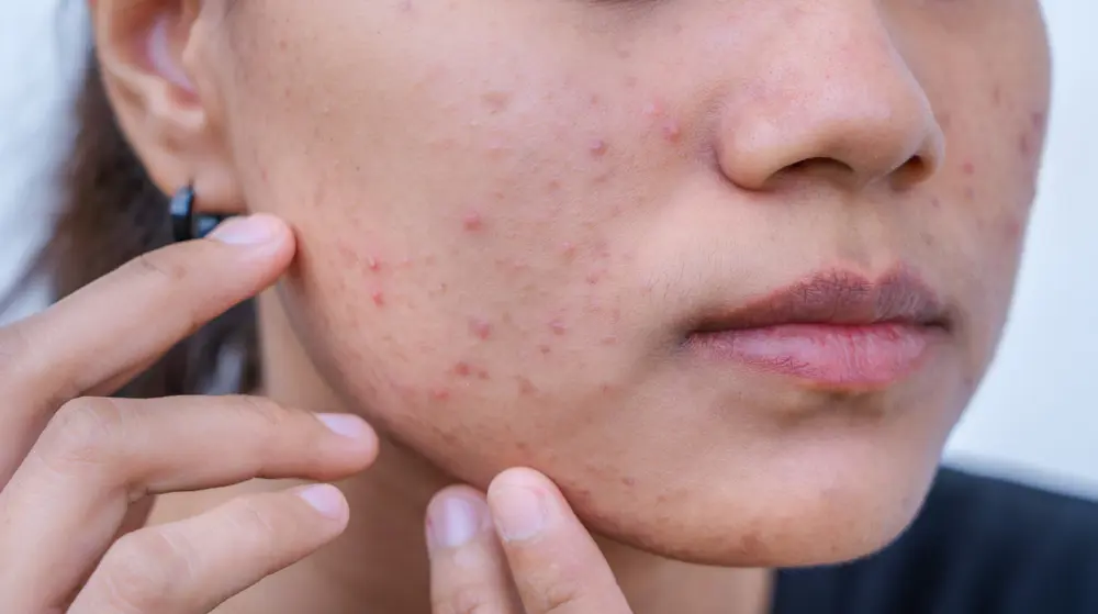 Acne and Scars