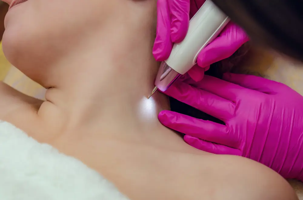 Skin Tags