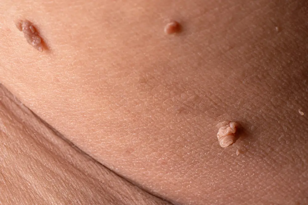 Skin Tags