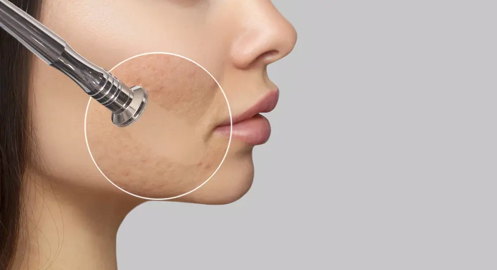 Skin Rejuvenation