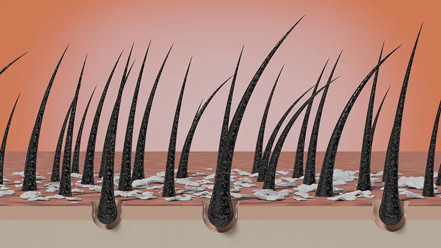 Anti-Dandruff Treatment