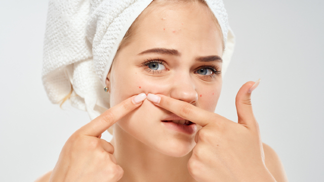 Acne scars.
