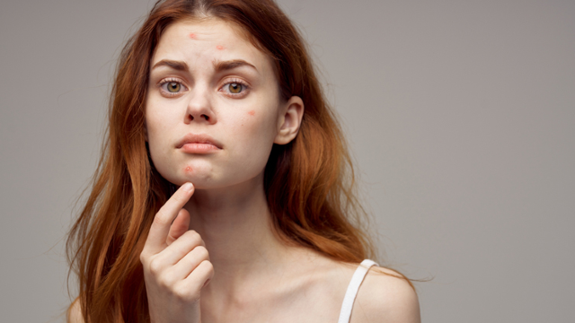 Inflammatory And Cystic Acne.