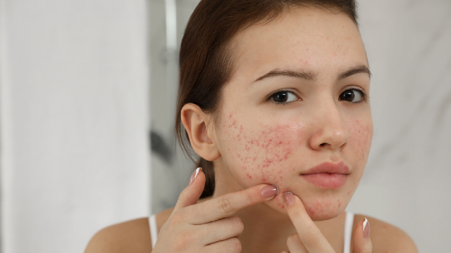 Acne scars.
