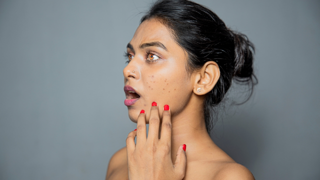 Acne scars.