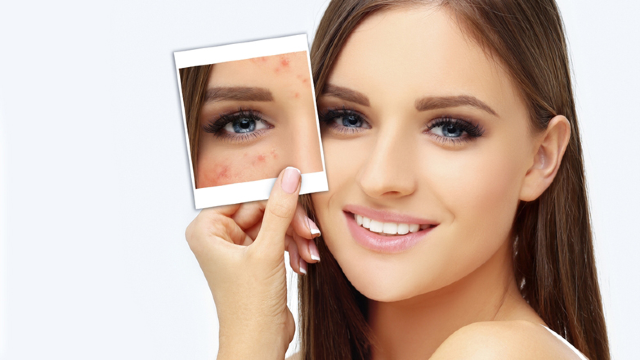 Acne Scar Treatment at Delight Dermatology Clinic.