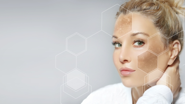 Melasma Treatment.
