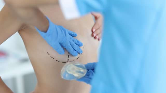 Doctor marking a patient’s breasts before breast surgery.