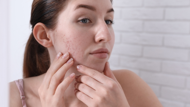 Women Suffering with Pores.
