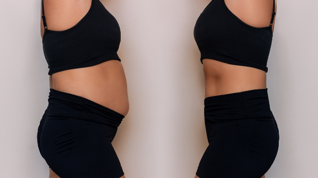 Before-and-after comparison showing changes in body contour during recovery after liposuction.