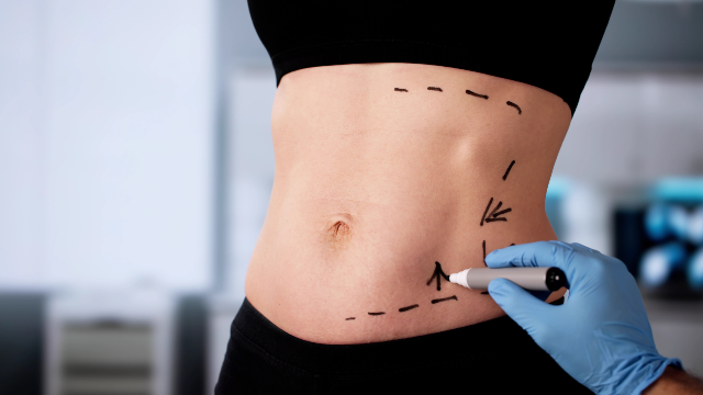 Doctor marking a patient’s stomach before liposuction surgery.