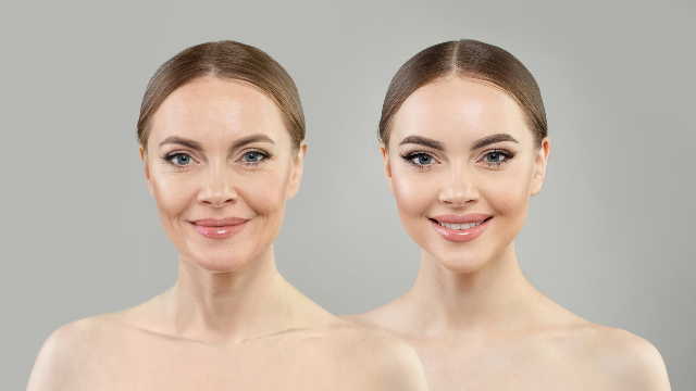 Before-and-after comparison showing facial skin changes following XERF skin tightening treatment.