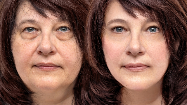Skin tightening before and after: treatment results showing smoother, firmer facial skin