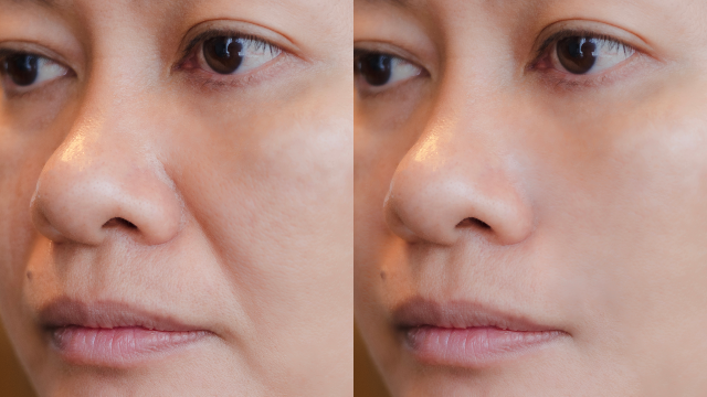 Before-and-after comparison showing smoother facial skin texture and improved skin hydration following skin booster treatment.
