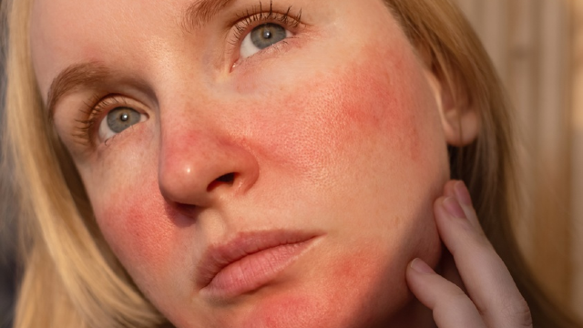 Laser skin treatment risk — facial redness and erythema across cheeks and nose as a documented post-procedure side effect