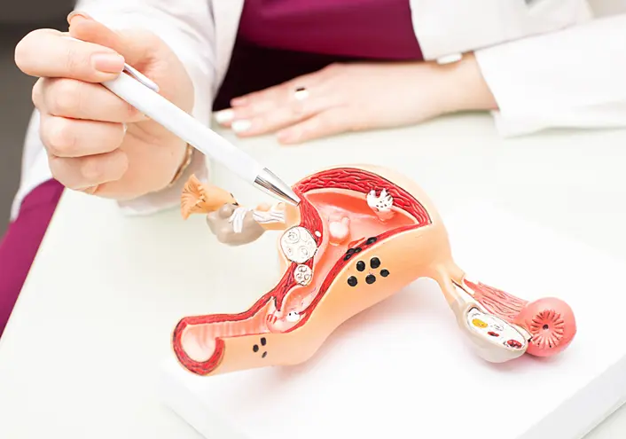 Physician explaining uterine conditions using an anatomical uterus model