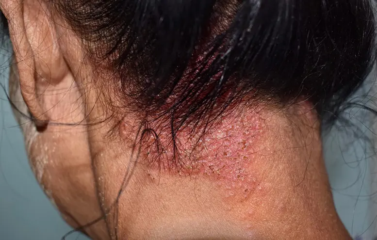 Skin Infections