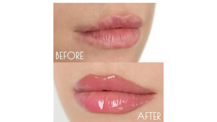 Lip Pigmentation