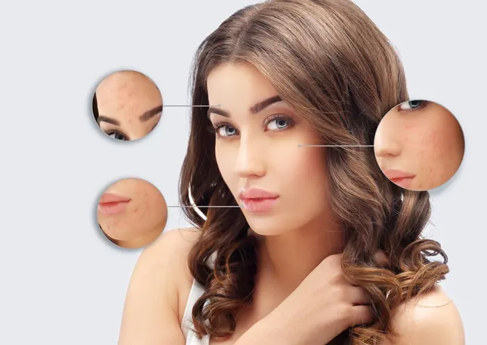 Acne scars